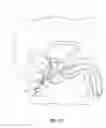 Fig. 07 - Intracavity balloon catheter