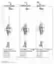 Fig. 22 - Graphical representation of a dynamic knee score for a knee surgery
