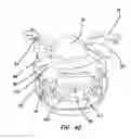 Fig. 09 - Hysterectomy model
