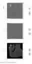 Fig. 13 - Method and system of teeth alignment based on simulating of crown and root movement