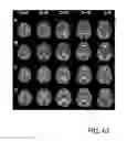 Fig. 65 - SYSTEM AND METHOD FOR MULTI-MODALITY QUANTIFICATION OF NEUROINFLAMMATION IN CENTRAL NERVOUS SYSTEM DISEASES