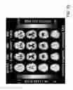 Fig. 68 - SYSTEM AND METHOD FOR MULTI-MODALITY QUANTIFICATION OF NEUROINFLAMMATION IN CENTRAL NERVOUS SYSTEM DISEASES