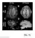 Fig. 75 - SYSTEM AND METHOD FOR MULTI-MODALITY QUANTIFICATION OF NEUROINFLAMMATION IN CENTRAL NERVOUS SYSTEM DISEASES