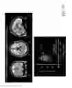 Fig. 84 - SYSTEM AND METHOD FOR MULTI-MODALITY QUANTIFICATION OF NEUROINFLAMMATION IN CENTRAL NERVOUS SYSTEM DISEASES
