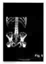 Fig. 07 - Method, Device and Computer Program for Automatic Estimation of Bone Region in CT