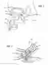 Fig. 02 - Flexible system for delivering an anchor