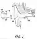 Fig. 02 - Sound attenuation earplug system and method of manufacture
