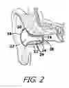 Fig. 03 - Sound attenuation earplug system and method of manufacture
