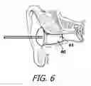 Fig. 07 - Sound attenuation earplug system and method of manufacture