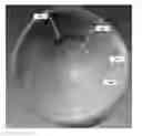 Fig. 01 - Prosthetic lenses and methods of making the same