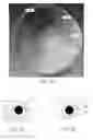 Fig. 06 - Prosthetic lenses and methods of making the same