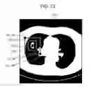 Fig. 72 - Control method and non-transitory computer-readable recording medium for comparing medical images