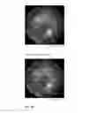 Fig. 22 - Wide field fundus camera with auto-montage at a single alignment