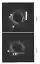 Fig. 09 - Identification of elastic lamina to guide interventional therapy