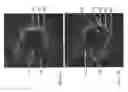 Fig. 22 - Identification of elastic lamina to guide interventional therapy