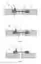 Fig. 02 - Implantable distraction device