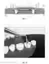 Fig. 09 - Composite restoration condenser with rolling ball tip