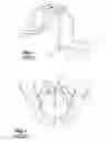 Fig. 02 - Palatal expansion device (palatal expander)