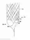 Fig. 01 - Anti-Aspiration Prosthesis