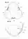 Fig. 09 - Prosthetic heart valve