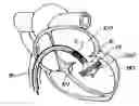 Fig. 01 - Percutaneous heart valve prosthesis