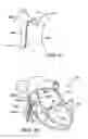Fig. 06 - Percutaneous heart valve prosthesis