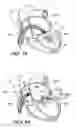 Fig. 08 - Percutaneous heart valve prosthesis