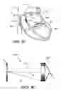 Fig. 09 - Percutaneous heart valve prosthesis