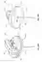 Fig. 34 - Safety Needle Set For Delivering Fluid To An Access Port