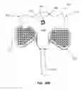 Fig. 40 - Safety Needle Set For Delivering Fluid To An Access Port