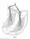 Fig. 02 - Hanging chair with collapsible spreader bar