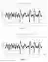 Fig. 08 - Use of a progressive compression encoding of physiologic waveform data in an implantable device to support discontinuing transmission of low-value data