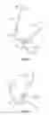 Fig. 07 - Suture passer systems and methods for tongue or other tissue suspension and compression