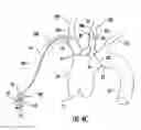 Fig. 07 - Occluding catheter with an optional common inflation and guideware channel and method of use