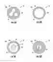 Fig. 12 - Occluding catheter with an optional common inflation and guideware channel and method of use