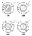 Fig. 15 - Occluding catheter with an optional common inflation and guideware channel and method of use