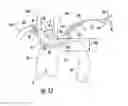 Fig. 24 - Occluding catheter with an optional common inflation and guideware channel and method of use