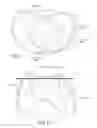 Fig. 09 - Modular total knee arthroplasty system and method