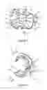 Fig. 03 - Surgical guide for positioning a resurfacing head implant