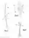 Fig. 04 - Patient-specific knee alignment guide and associated method