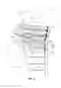 Fig. 06 - Fixation device for proximal humerus fractures