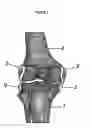 Fig. 02 - Prosthesis