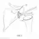Fig. 03 - Robotic shoulder repair and reconstruction