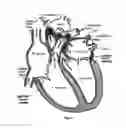 Fig. 02 - DEVICES AND METHOD FOR MODIFYING BLOOD PRESSURE IN THE LUNGS AND PULMONARY VASCULATURE BY IMPLANTING  FLOW MODIFIER(S) IN PULMONARY VEIN(S)