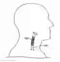 Fig. 01 - Methods, systems and devices for treatment of cerebrospinal venous insufficiency and multiple sclerosis
