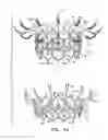 Fig. 02 - Prosthetic heart valve with pouch