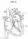 Fig. 04 - Delivery systems and methods for transcatheter prosthetic valves