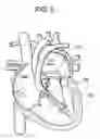Fig. 06 - Delivery systems and methods for transcatheter prosthetic valves