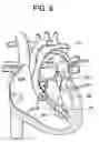 Fig. 07 - Delivery systems and methods for transcatheter prosthetic valves
