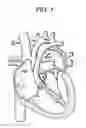 Fig. 08 - Delivery systems and methods for transcatheter prosthetic valves
